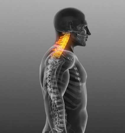 Neck Pain